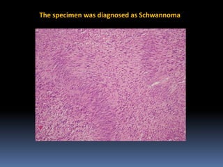 The specimen was diagnosed as Schwannoma

 