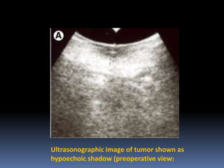 Ultrasonographic image of tumor shown as
hypoechoic shadow (preoperative view)

 