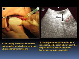 Needle being introduced to indicate
deep surgical margin clearance under
ultrasonographic monitoring

Ultrasonographic image of tumor with
the needle positioned at 10 mm from the
deepest invasive front of the tumor
Red arrows showing the needle.

 