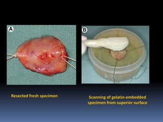 Resected fresh specimen

Scanning of gelatin-embedded
specimen from superior surface

 