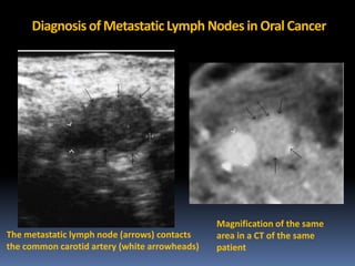 Diagnosis of Metastatic Lymph Nodes in Oral Cancer

The metastatic lymph node (arrows) contacts
the common carotid artery (white arrowheads)

Magnification of the same
area in a CT of the same
patient

 