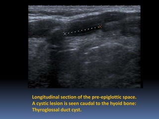 Longitudinal section of the pre-epiglottic space.
A cystic lesion is seen caudal to the hyoid bone:
Thyroglossal duct cyst.

 