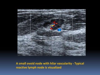 A small ovoid node with hilar vascularity - Typical
reactive lymph node is visualized

 