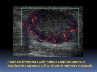 A rounded lymph node with multiple peripheral arteries is
visualized in a squamous cell carcinoma lymph node metastasis

 