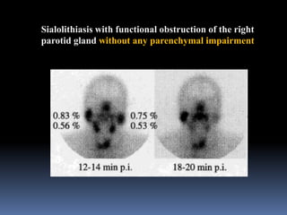 Sialolithiasis with functional obstruction of the right
parotid gland without any parenchymal impairment

 