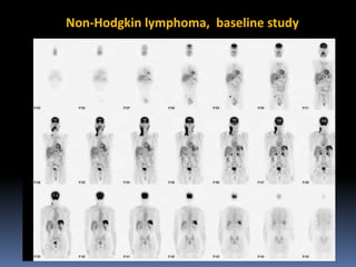 Non-Hodgkin lymphoma, baseline study

 
