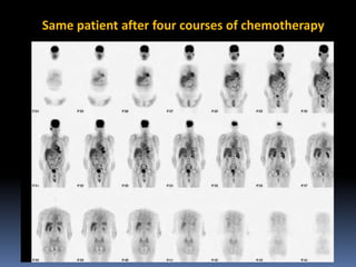 Same patient after four courses of chemotherapy

 