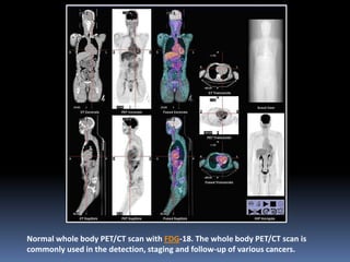 Normal whole body PET/CT scan with FDG-18. The whole body PET/CT scan is
commonly used in the detection, staging and follow-up of various cancers.

 