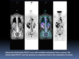 Abnormal whole body PET/CT scan with multiple metastases from a cancer. The
whole body PET/CT scan has become an important tool in the evaluation of cancer.

 