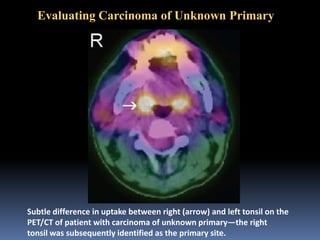 Evaluating Carcinoma of Unknown Primary

Subtle difference in uptake between right (arrow) and left tonsil on the
PET/CT of patient with carcinoma of unknown primary—the right
tonsil was subsequently identified as the primary site.

 