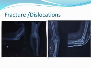 Fracture /Dislocations
 