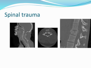 Spinal trauma
 