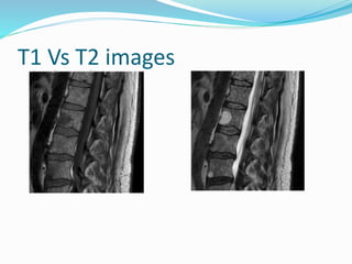 T1 Vs T2 images
 