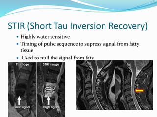 STIR (Short Tau Inversion Recovery)
 Highly water sensitive
 Timing of pulse sequence to supress signal from fatty
tissue
 Used to null the signal from fats
 