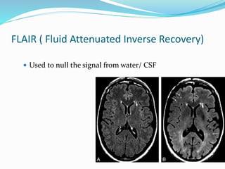 FLAIR ( Fluid Attenuated Inverse Recovery)
 Used to null the signal from water/ CSF
 