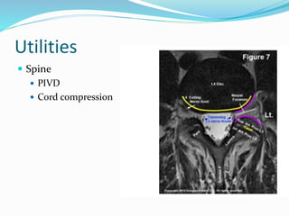 Utilities
 Spine
 PIVD
 Cord compression
 