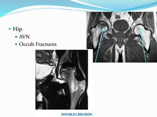  Hip
 AVN
 Occult Fractures
 