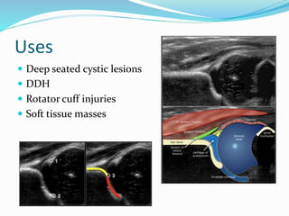 Uses
 Deep seated cystic lesions
 DDH
 Rotator cuff injuries
 Soft tissue masses
 