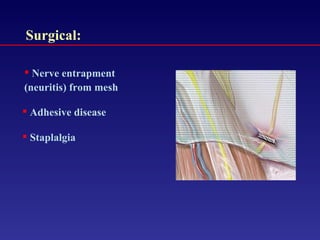Nerve entrapment (neuritis) from mesh Staplalgia Adhesive disease Surgical: 