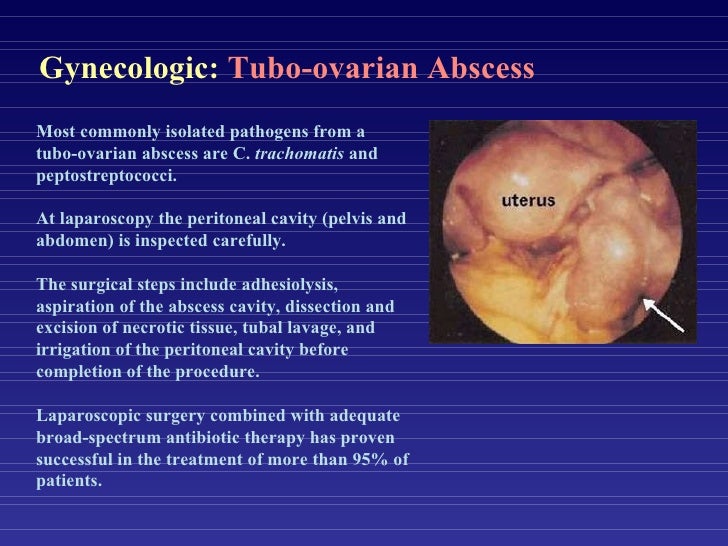 Diagnostic Laparoscopy for Pelvic Disorders