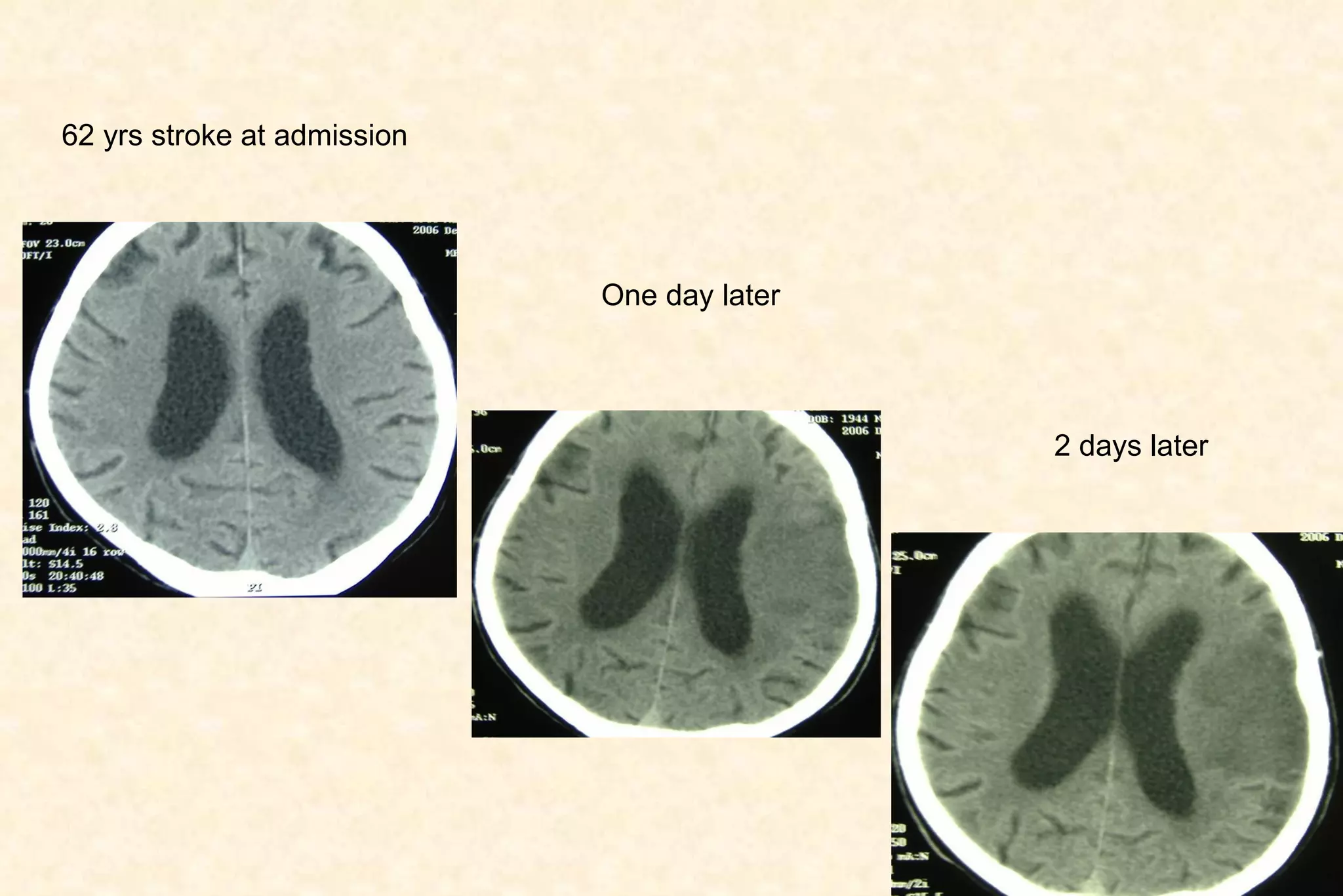 62 yrs stroke at admission One day later 2 days later 