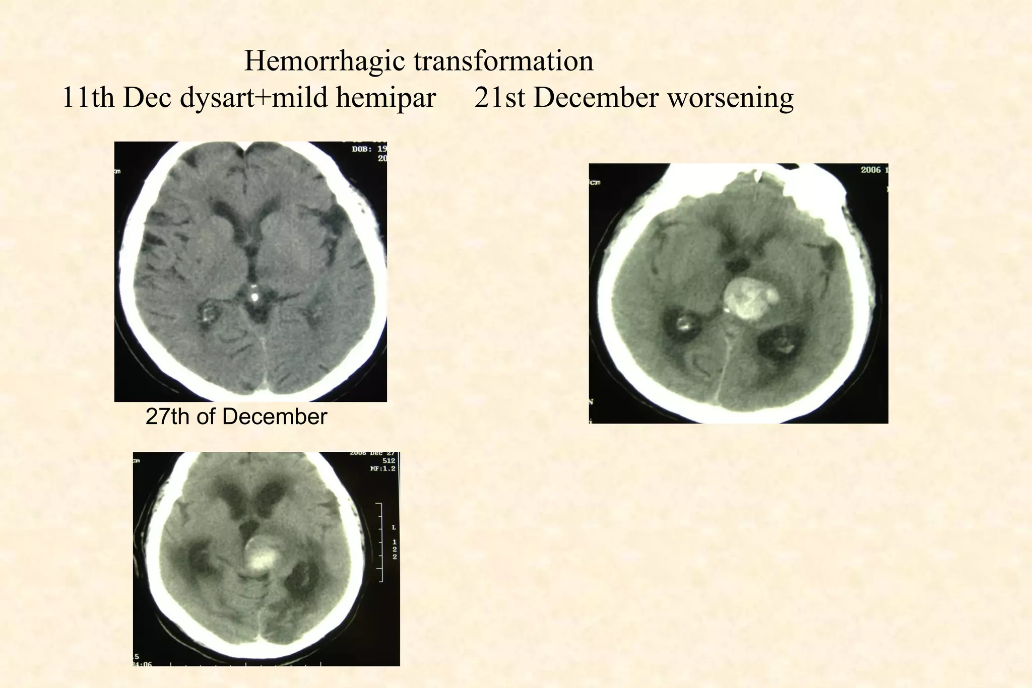 Hemorrhagic transformation 11th Dec dysart+mild hemipar  21st December worsening 27th of December 