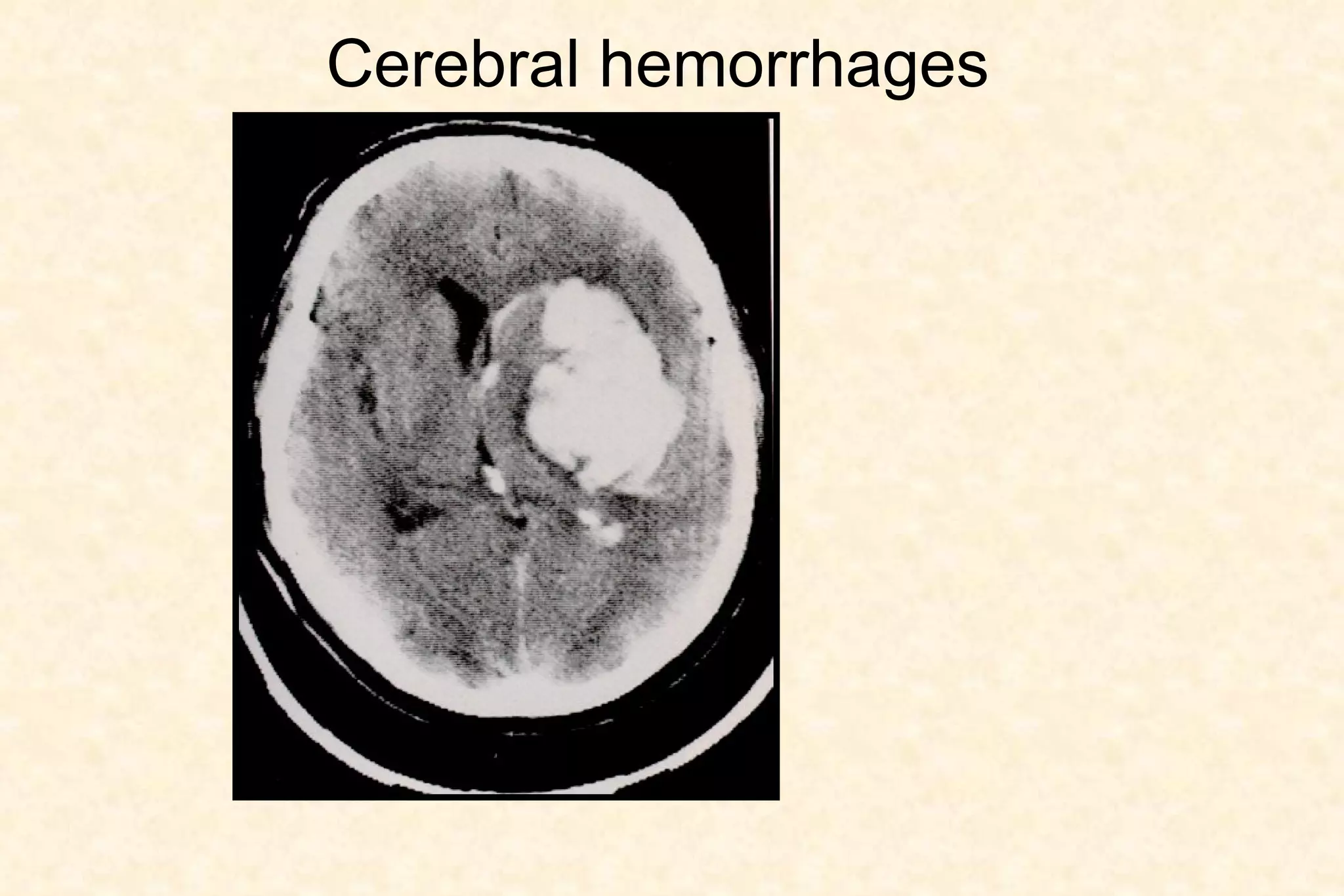 Cerebral hemorrhages 