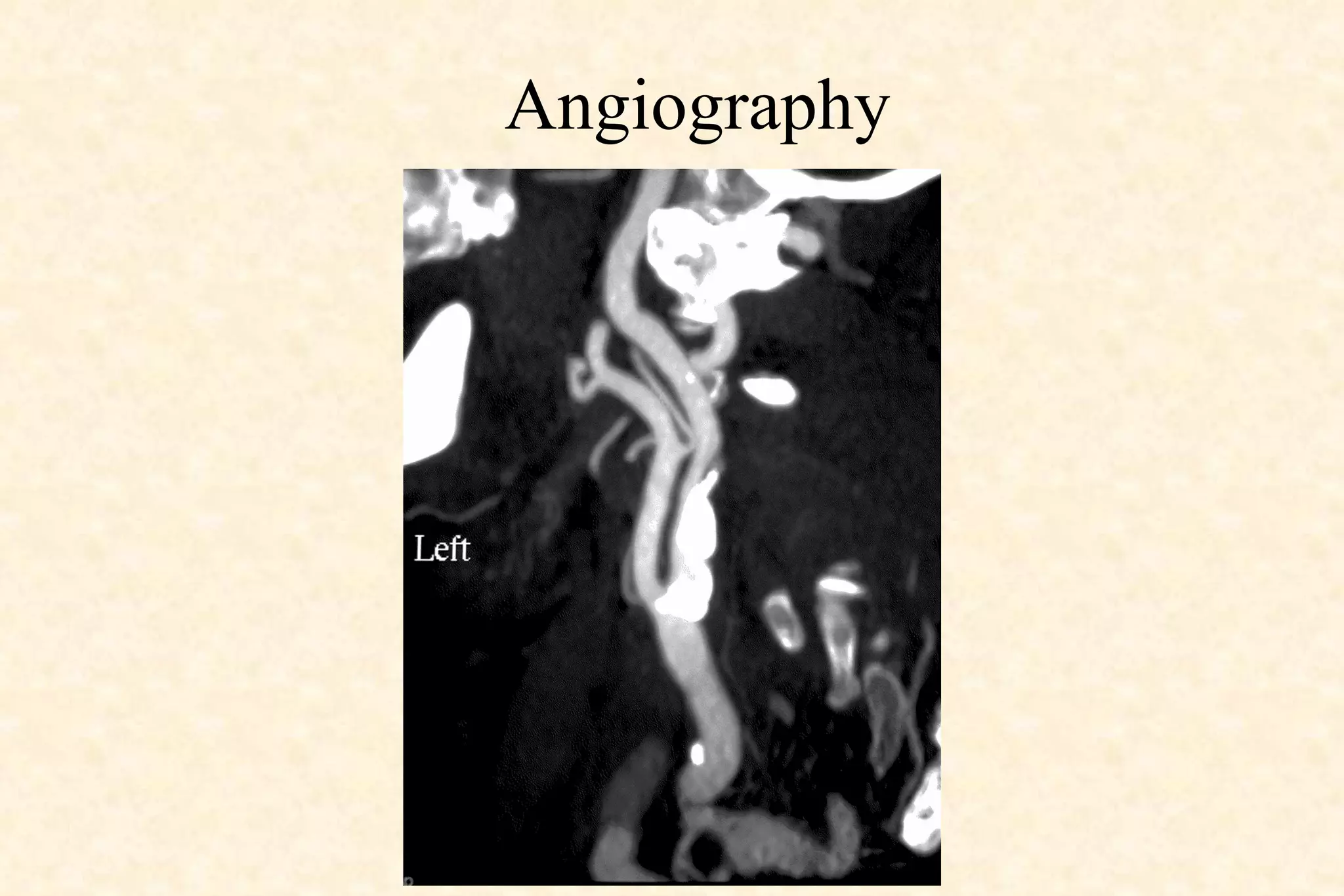 Angiography 