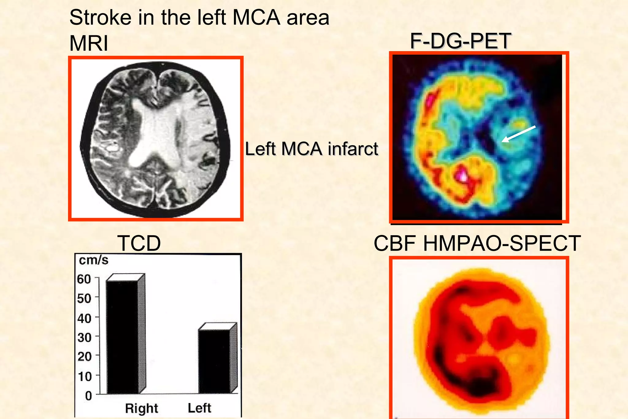Stroke in the left MCA area MRI TCD  CBF HMPAO-SPECT F-DG-PET Left MCA infarct 