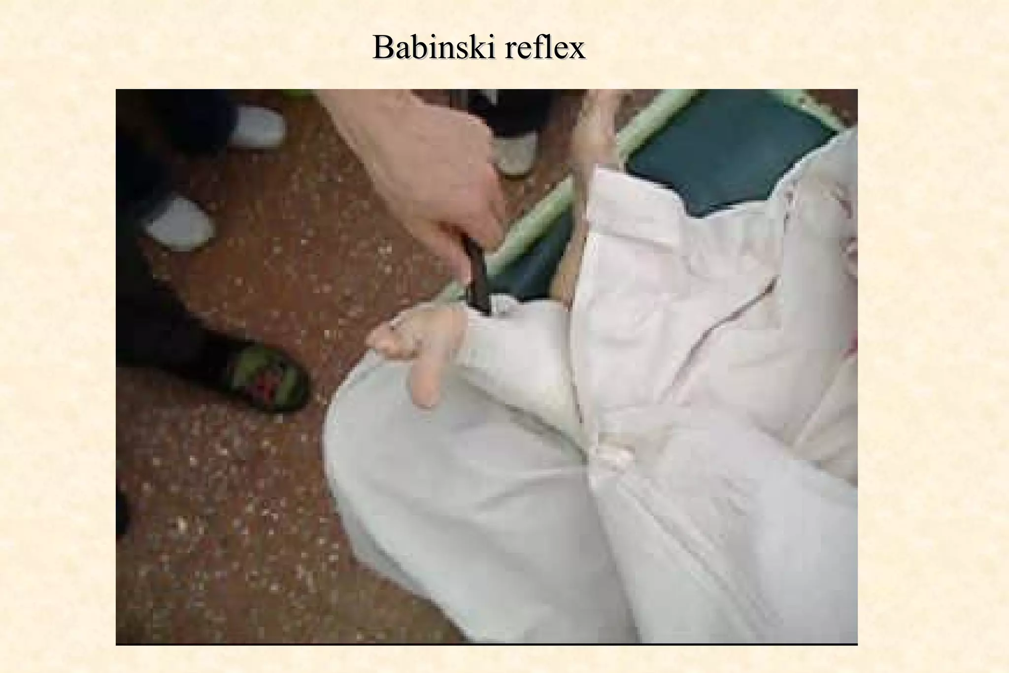 Babinski reflex 