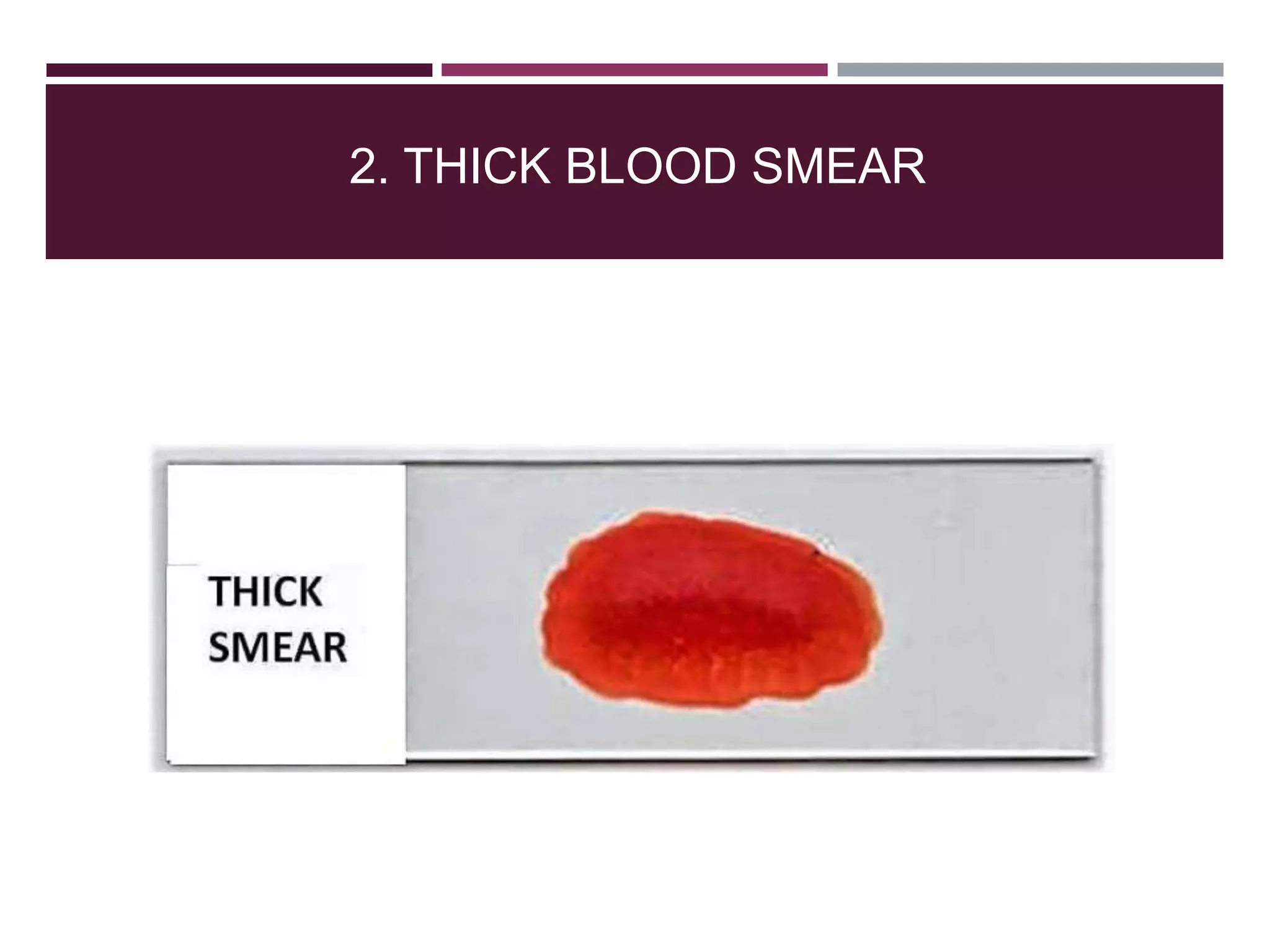 2. THICK BLOOD SMEAR
 