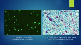 Coloration de Ziehl-Neelsen d’une biopsie
Cutanée : Mycobacterium leprae
Coloration a l’Auramine
Mycobacterium tuberculosis
 