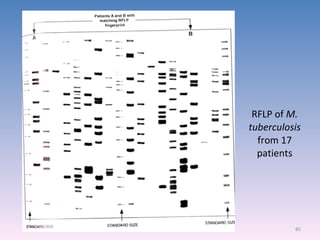 RFLP of  M. tuberculosis  from 17 patients 