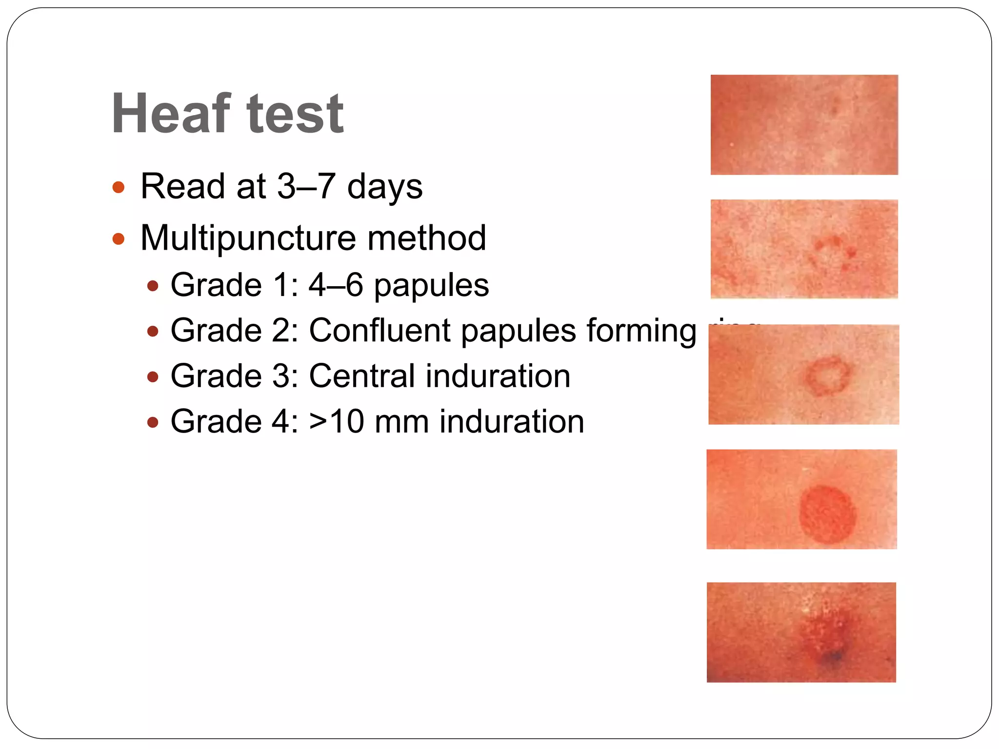 Heaf test
 Read at 3–7 days
 Multipuncture method
 Grade 1: 4–6 papules
 Grade 2: Confluent papules forming ring
 Grade 3: Central induration
 Grade 4: >10 mm induration
 