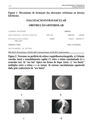 Manual de Diagnóstico e Tratamento de
104                                                                           Doenças Falciformes



Figura 1. Mecanismo de formação das alterações retinianas na doença
falciforme.
                      FALCIZAÇÃO INTRAVASCULAR
                       OBSTRUÇÃO ARTERIOLAR

ISQUEMIA RETINIANA                                               HMRAI
                                                                 EORGA

ANASTOMOSES ARTERIOVENOSA                 PRÉ-RET                      INTRA-RET         SUB-RET

N E O VASCULARIZAÇÃO                          SHSS
                                               CII                     “BLACK SUNBURST”
        ( S A FAN”)
         “E

HMRAI VTE
 EORGA ÍRA                                                            CRO IIECNE
                                                                       OPS RDSETS

DESCOLAMENTO DE RETINA

PRÉ-RET=Preretiniana, INTRA-RET=Intraretiniana, SUB-RET=Subretiniana

Figura 2. Neovasos na periferia da retina à angiofluoresceinografia. a) Oclusão
vascular (seta) e remodelamento capilar (*) entre a retina vascularizada (v) e
avascular (av). b) “sea fan” típico em forma de leque (seta). c) “sea fan(s)”
múltiplos entre a retina v e av (setas). d) extensa vascularização equatorial
dada pela coalescência de “sea fan(s)”.




              a                                           b




                  c                                       d
 