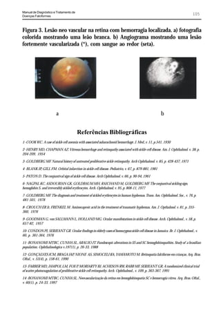 Manual de Diagnóstico e Tratamento de
Doenças Falciformes
                                                                                                                             105


Figura 3. Lesão neo vascular na retina com hemorragia localizada. a) fotografia
colorida mostrando uma leão branca. b) Angiograma mostrando uma lesão
fortemente vascularizada (*), com sangue ao redor (seta).




                         a                                                                             b


                                        Referências Bibliográficas
1- COOK WC. A case of sickle cell anemia with associated subarachnoid hemorrhage. J. Med.,v. 11, p.541, 1930

2- HENRY MD, CHAPMAN AZ. Vitreous hemorrhage and retinopathy associated with sickle-cell disease. Am. J. Ophthalmol. v. 38, p.
204-209, 1954

3- GOLDBERG MF. Natural history of untreated proliferative sickle retinopathy. Arch Ophthalmol. v. 85, p. 428-437, 1971

4- BLANK JP, GILL FM. Orbital infarction in sickle cell disease. Pediatrics, v. 67, p. 879-881, 1981

5- PATON D. The conjuntival sign of sickle cell disease. Arch Ophthalmol. v. 66, p. 90-94, 1961

6- NAGPAL KC, ASDOURIAN GK, GOLDBAUM MH, RAICHAND M, GOLDBERG MF. The conjuntival sickling sign,
hemoglobin S, and irreversibly sickled erythrocytes. Arch. Ophthalmol, v. 95, p. 808-11, 1977

7- GOLDBERG MF. The diagnosis and treatment of sickled erythrocytes in human hyphemas. Trans. Am. Ophthalmol. Soc., v. 76, p.
481-501, 1978

8- CROUCH ER Jr, FRENKEL M. Aminocaproic acid in the treatment of traumatic hyphemas. Am. J. Opthalmol. v. 81, p. 355-
360, 1976

9- GOODMAN G, von SALLMANN L, HOLLAND MG. Ocular manifestations in sickle cell disease. Arch. Ophthalmol., v. 58, p.
657-82, 1957

10- CONDON PI, SERJEANT GR. Ocular findings in elderly cases of homozygous sickle cell disease in Jamaica. Br. J. Ophthalmol., v.
60, p. 361-364, 1976

11- BONANOMI MTBC, CUNHA SL, ARAUJO JT. Fundoscopic alterations in SS and SC hemoglobinopathies. Study of a brasilian
population. Ophthalmologica v.197(1), p. 26-33, 1988

12- GONÇALVES JCM, BRAGA JAP, NIONE AS, SIMOCELI RA, YAMAMOTO M. Retinopatia falciforme em crianças. Arq. Bras.
Oftal., v. 53(4), p. 158-61, 1990

13- FARBER MD, JAMPOL LM, FOX P, MORIARTY BJ, ACHESON RW, RABB MF, SERJEANT GR, A randomized clinical trial
of scatter photocoagulation of proliferative sickle cell retinopathy. Arch. Ophthalmol., v. 109, p. 363-367, 1991

14- BONANOMI MTBC, CUNHA SL. Neovascularização da retina em hemoglobinopatia SC e hemorragia vítrea. Arq. Bras. Oftal.,
v. 60(1), p. 24-33, 1997
 