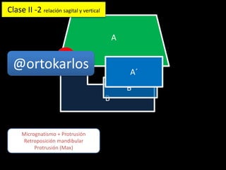 A
B
B´
A´
Micrognatismo + Protrusión
Retroposición mandibular
Protrusión (Max)
Clase II -2 relación sagital y vertical
@ortokarlos
 