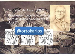 Definición de Angle (1917)
Maloclusión: aquella relación de
mordida que no coincida con la
clase I
@ortokarlos
 