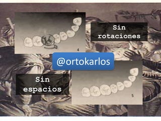 5
4
Sin
rotaciones
Sin
espacios
@ortokarlos
 