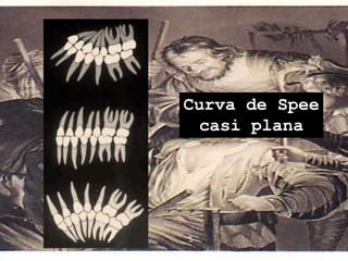 Curva de Spee
casi plana
5
 