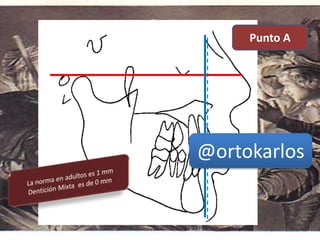 1 mm
Punto A
@ortokarlos
 