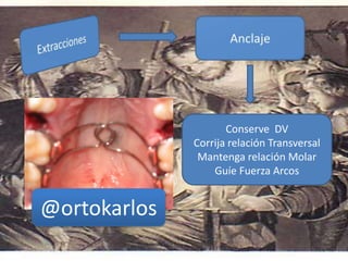 Conserve DV
Corrija relación Transversal
Mantenga relación Molar
Guíe Fuerza Arcos
@ortokarlos
 
