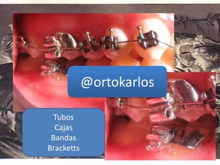 Tubos
Cajas
Bandas
Bracketts
@ortokarlos
 