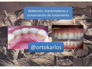 Retención, mantenedores y
conservación de tratamiento
@ortokarlos
 