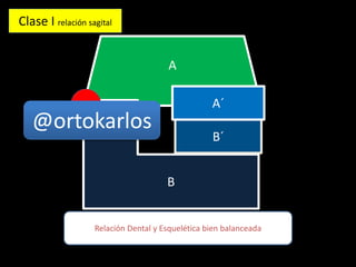 A
B
B´
A´
Relación Dental y Esquelética bien balanceada
Clase I relación sagital
@ortokarlos
 