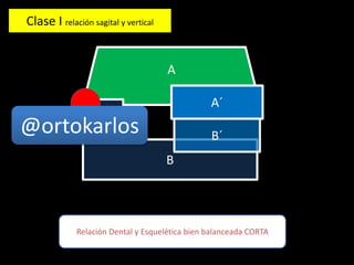 A
B
B´
A´
Relación Dental y Esquelética bien balanceada CORTA
Clase I relación sagital y vertical
@ortokarlos
 