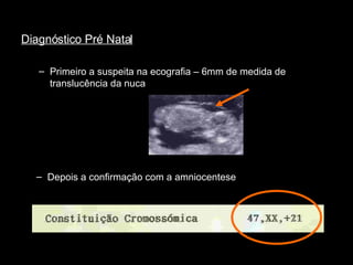 Diagnóstico Pré Natal Primeiro a suspeita na ecografia – 6mm de medida de translucência da nuca Depois a confirmação com a amniocentese 