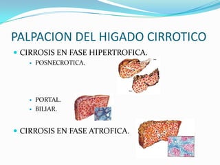 PALPACION DEL HIGADO CIRROTICO
 CIRROSIS EN FASE HIPERTROFICA.
 POSNECROTICA.
 PORTAL.
 BILIAR.
 CIRROSIS EN FASE ATROFICA.
 