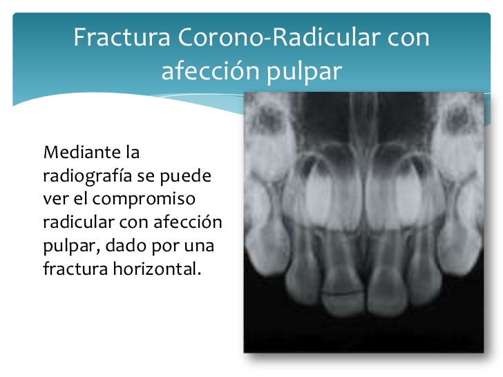 que es sin compromiso radicular