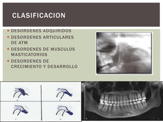 CLASIFICACION 
 DESORDENES ADQUIRIDOS 
 DESORDENES ARTICULARES 
DE ATM 
 DESORDENES DE MUSCULOS 
MASTICATORIOS 
 DESORDENES DE 
CRECIMIENTO Y DESARROLLO 
 